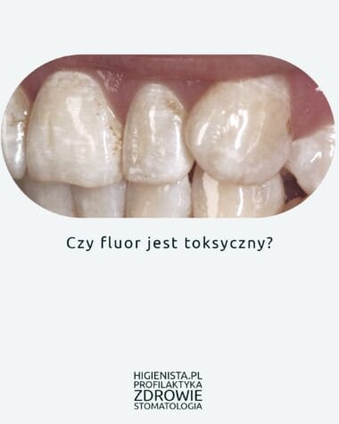 Okładka - zęby fluoroza