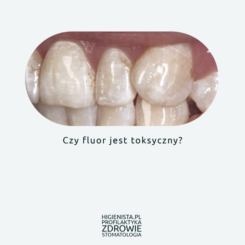 Okładka - zęby fluoroza